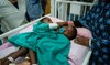 Saudi doctors operate on conjoined twins from Burkina Faso