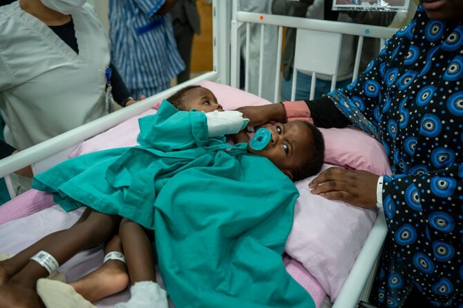 Saudi doctors operate on conjoined twins from Burkina Faso